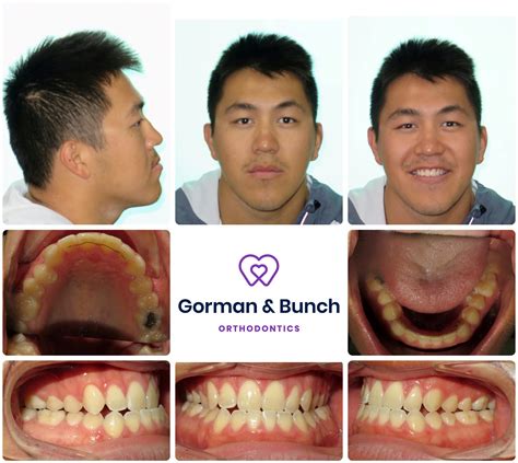 invisalign before and after underbite